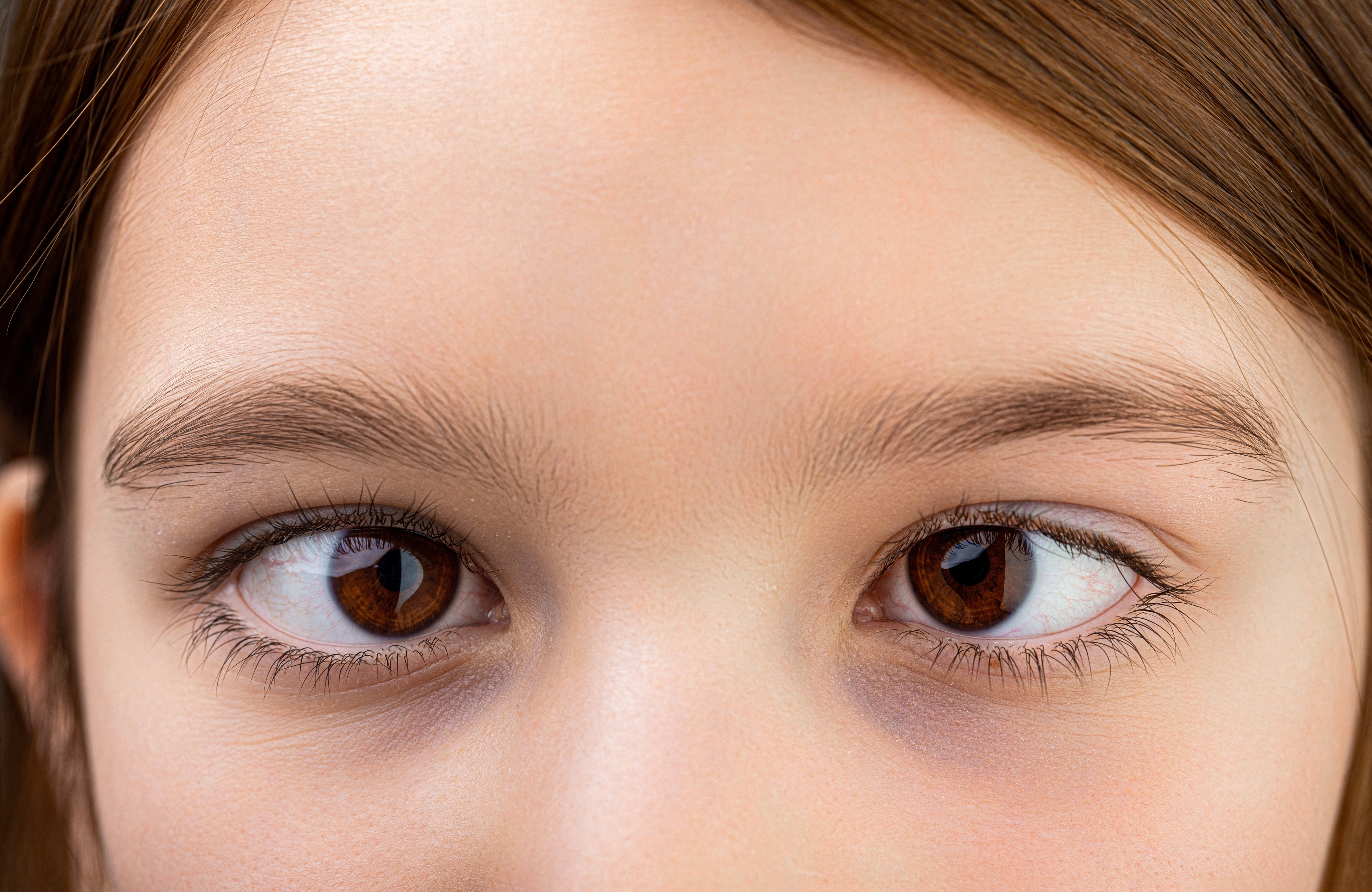 Strabismus (Cross-Eye)