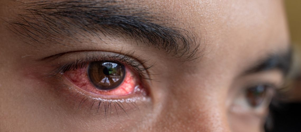 Conjunctivitis (Pink Eye)