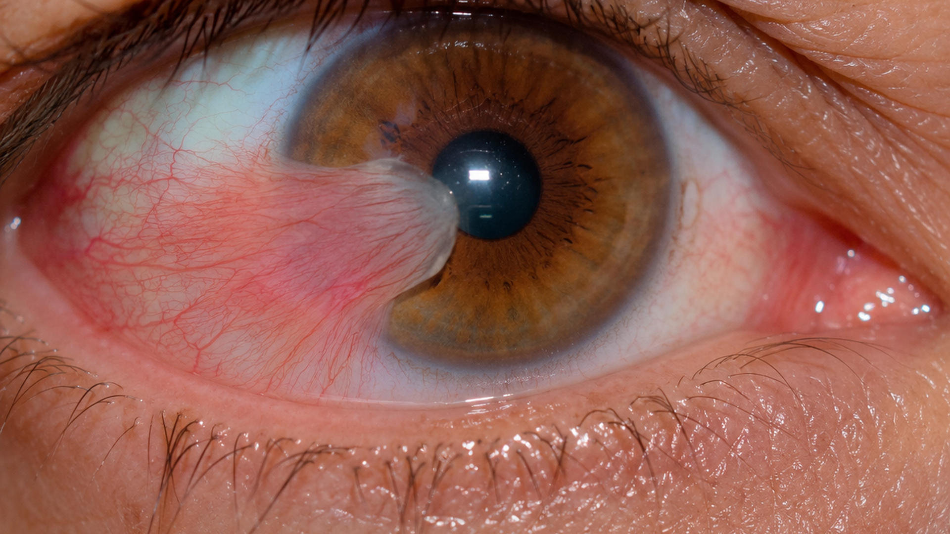 Pterygium